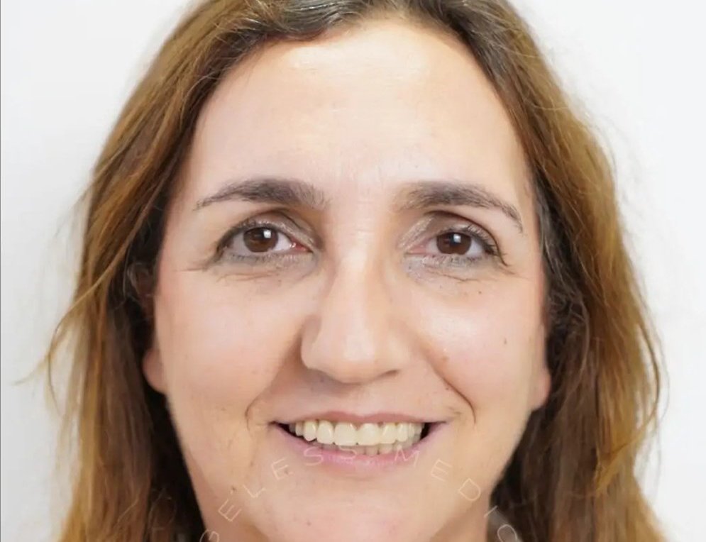 Antes — Reabilitação do sorriso, caso real tratado na Dare Clinic
