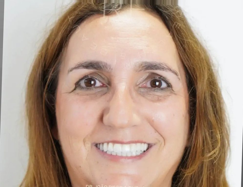 Depois — Reabilitação do sorriso, caso real tratado na Dare Clinic
