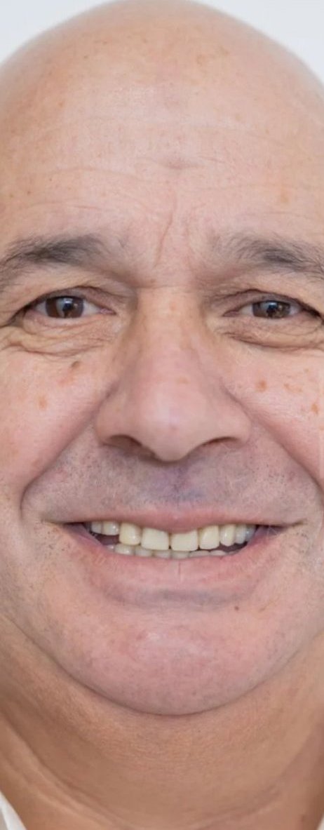Antes — Reabilitação total, caso real tratado na Dare Clinic